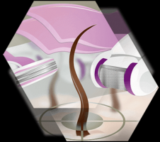 kliniken zur narbenentfernung mit laser mannheim Haarfreiheit Mannheim - dauerhafte Haarentfernung