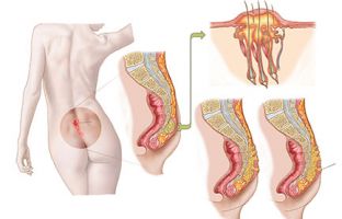 Minimalinvasive Therapie der Steißbeinfistel / Sinus pilonidalis mittels pit picking